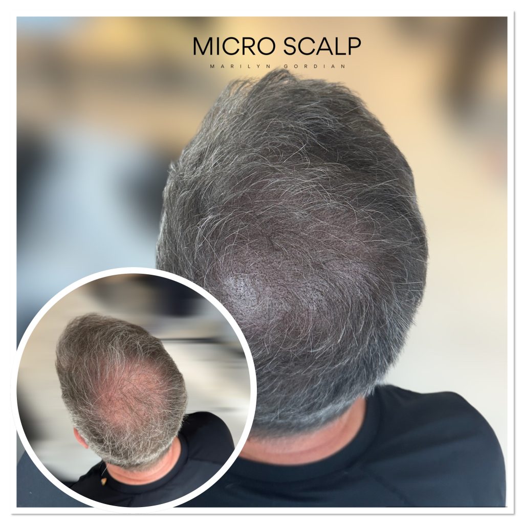 alt="Résultats avant et après micropigmentation capillaire" alt="client micro scalp en micropigmentation capillaire"
