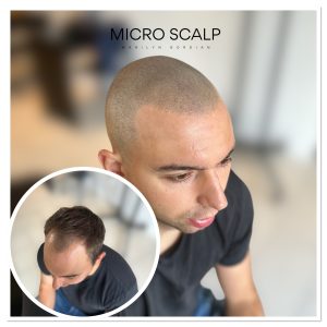 alt="Résultats avant et après micropigmentation capillaire"
alt="solution contre la calvitie" alt="solutions pour la calvitie" 