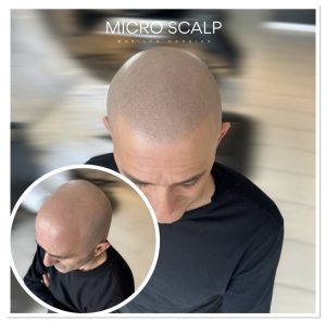 alt="Résultats avant et après micropigmentation capillaire" alt="traitement en micropigmentation capillaire" alt="traitement en micropigmentation capillaire a montreal"