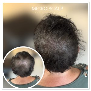 alt=“Avant et après micropigmentation pour alopécie androgénétique chez les femmes” alt=“Résultat de la micropigmentation capillaire chez une femme”