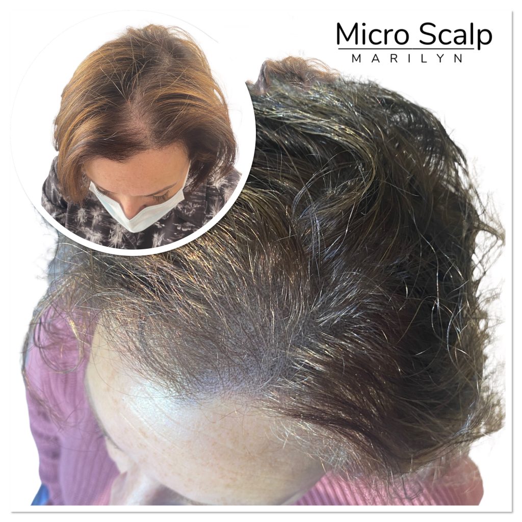 alt="Femme avec micropigmentation capillaire chez MicroScalp Marilyn"