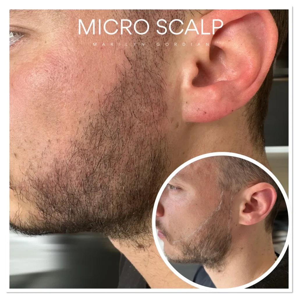 alt="Avant et après micropigmentation de la barbe". alt : "densité barbe micropigmentation capillaire "