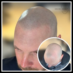 alt="calvitie masculine" alt="avant après micropigmentation chez microscalp"