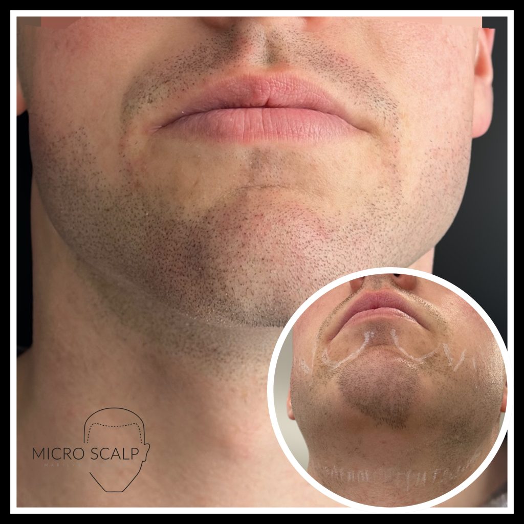 Micropigmentation de la barbe, pelade areata barbe, scalp micropigmentation