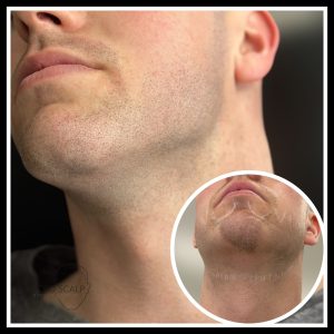 Micropigmentation de la barbe, pelade areata barbe, scalp micropigmentation