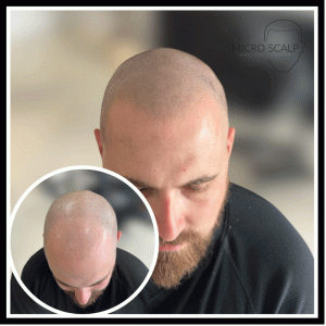 alt="Technique de micropigmentation capillaire chez MicroScalp Marilyn"