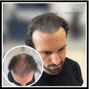 alt="Résultats avant et après micropigmentation capillaire" alt="client microscalp avec greffe de cheveux" alt="client microscalp avec traitement compatible avec la micropigmentation capillaire"